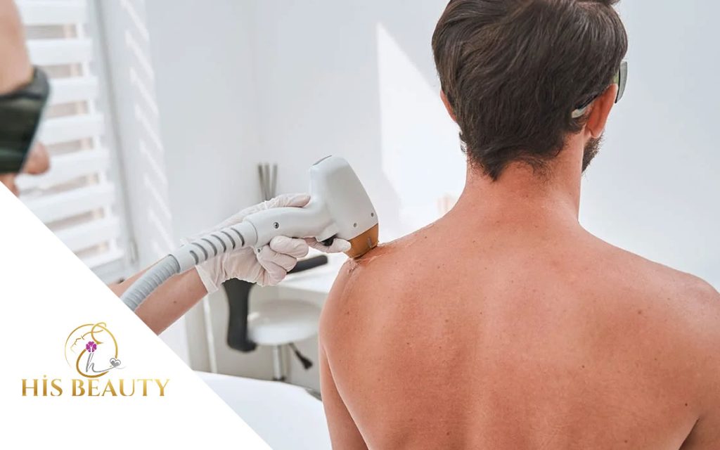 Sırt Bölgesi Lazer Epilasyon Sakarya